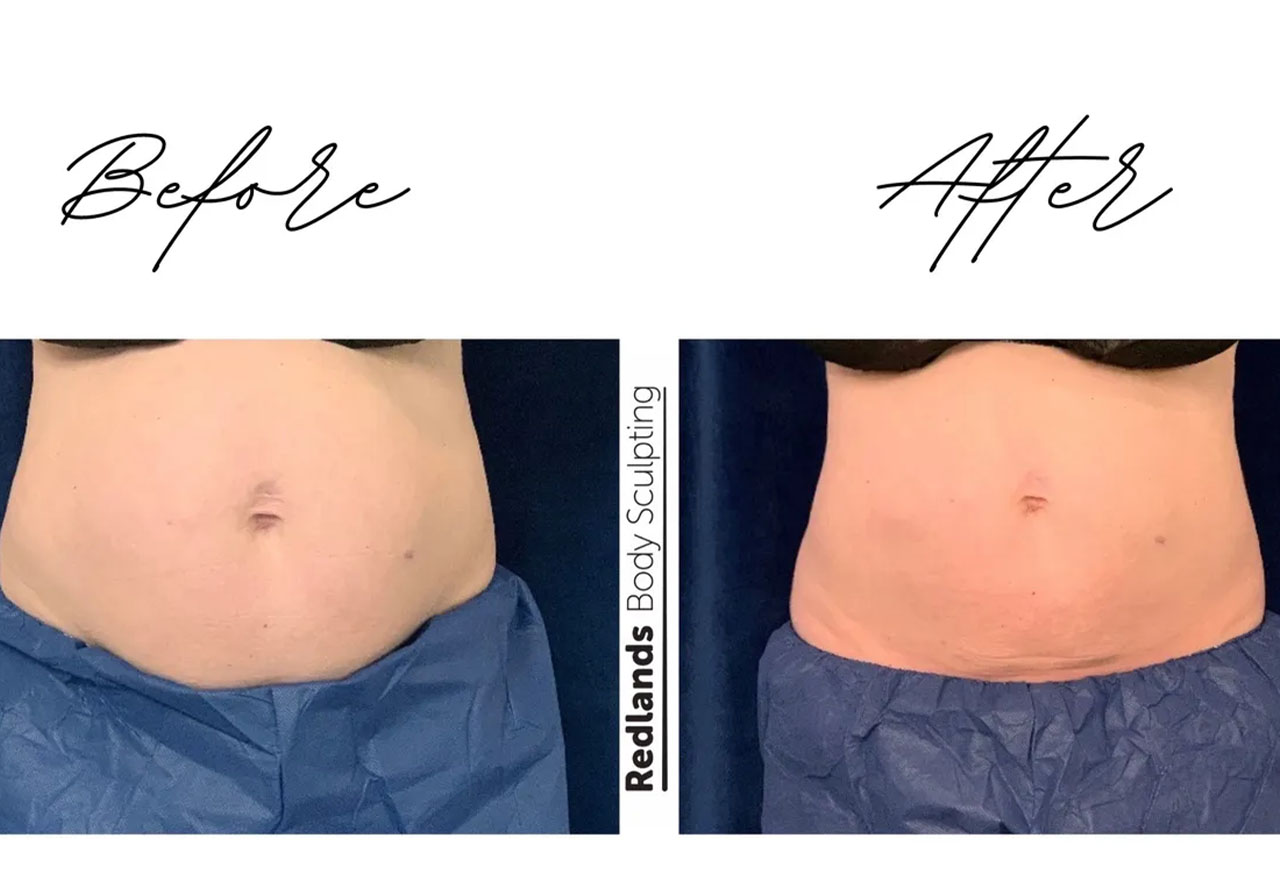 before and after abdomen coolsculpting treatment at RedLands Body Sculpting with Dr. Aya in California