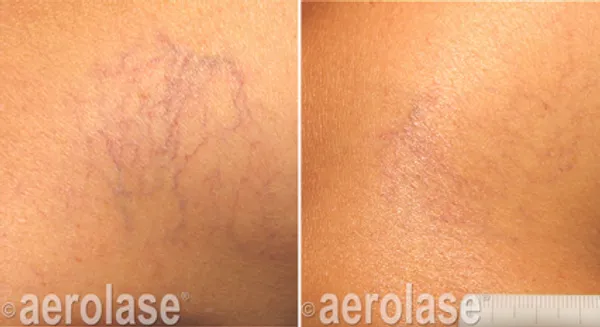 before and after aerolase laser treatment at RedLands Body Sculpting with Dr. Aya in California