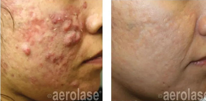 before and after neoclear acne treatment at RedLands Body Sculpting with Dr. Aya in California