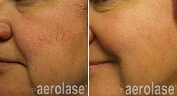 before and after aerolase laser treatment at RedLands Body Sculpting with Dr. Aya in California