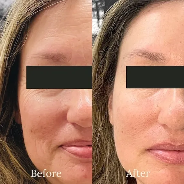 before and after injectables treatment at RedLands Body Sculpting with Dr. Aya in California