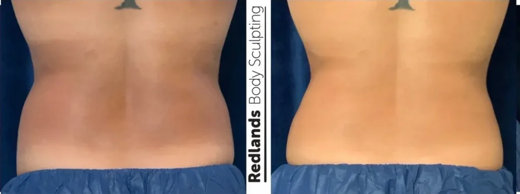 CoolSculpting Before and After photo by Redlands Body Sculpting in Redlands, CA
