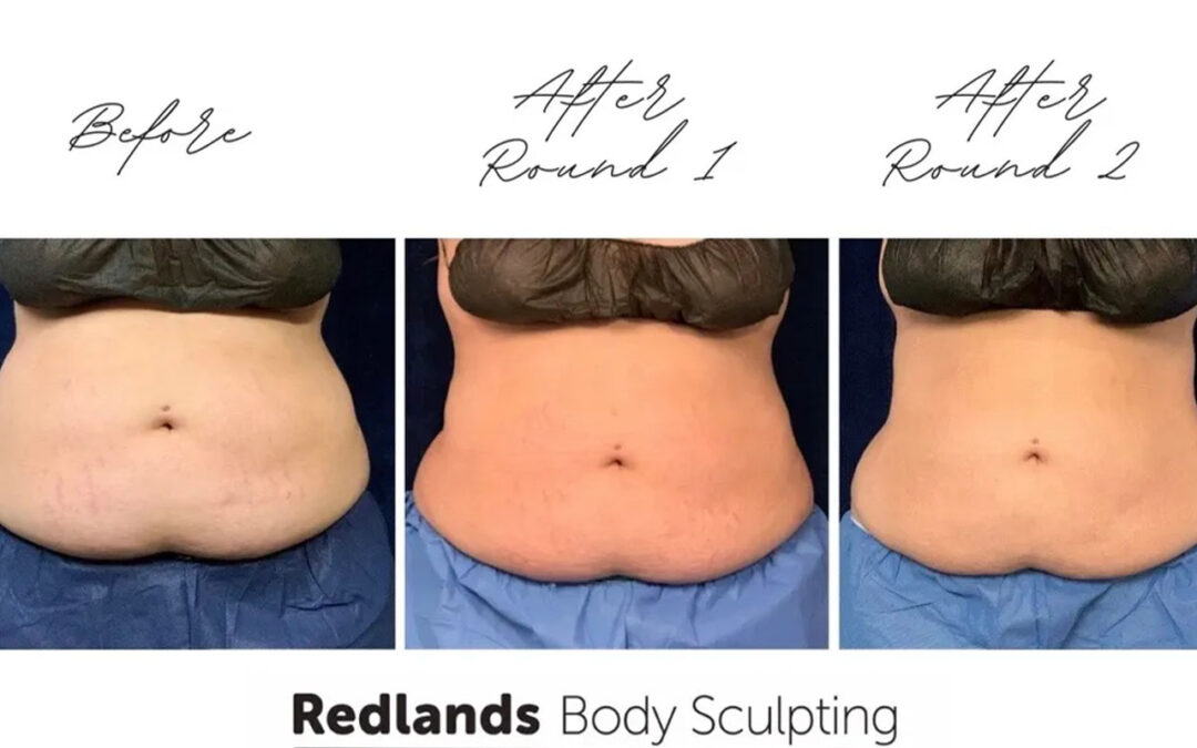 before and after abdomen coolsculpting treatment at RedLands Body Sculpting with Dr. Aya in California
