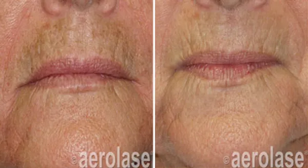 before and after aerolase laser treatment at RedLands Body Sculpting with Dr. Aya in California