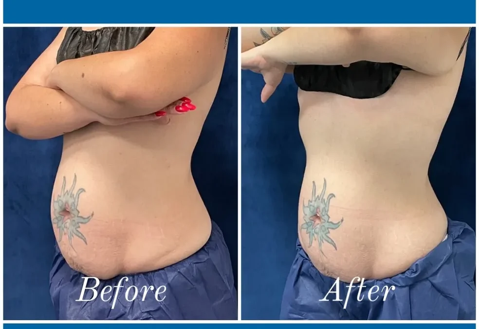 before and after abdomen coolsculpting treatment at RedLands Body Sculpting with Dr. Aya in California