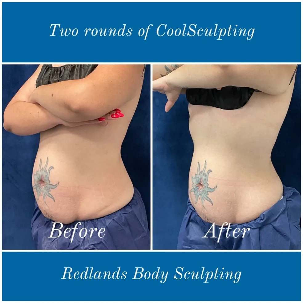 before and after abdomen coolsculpting treatment at RedLands Body Sculpting with Dr. Aya in California