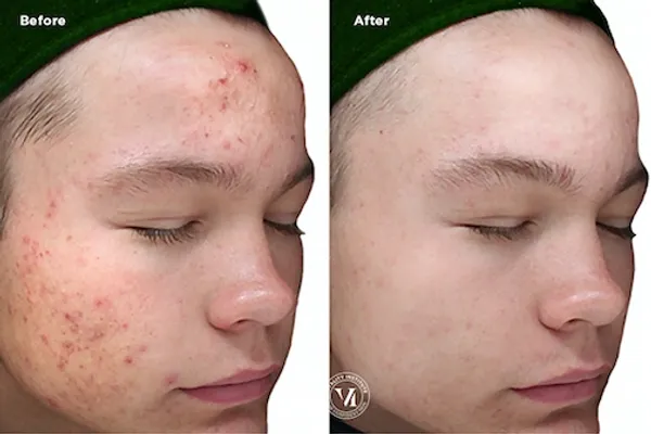 before and after aerolase laser treatment at RedLands Body Sculpting with Dr. Aya in California