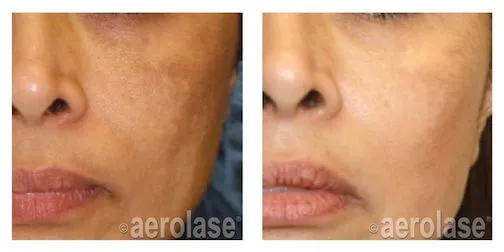 before and after aerolase melasma treatment redlands body sculpting