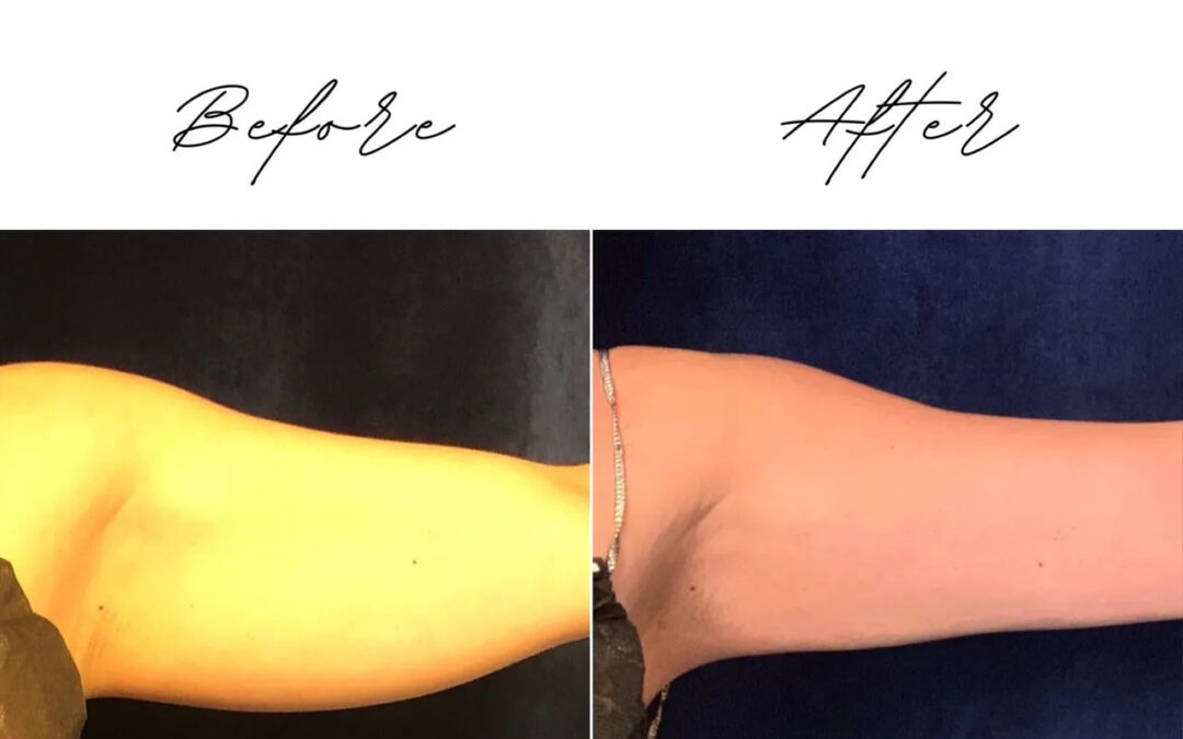 before and after arm coolsculpting treatment at RedLands Body Sculpting with Dr. Aya in California