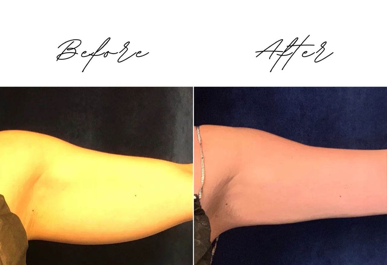 before and after arm coolsculpting treatment at RedLands Body Sculpting with Dr. Aya in California