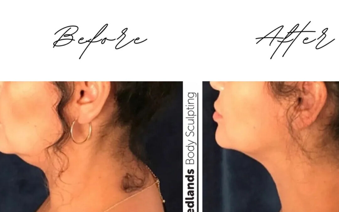 before and after chin coolsculpting treatment at RedLands Body Sculpting with Dr. Aya in California