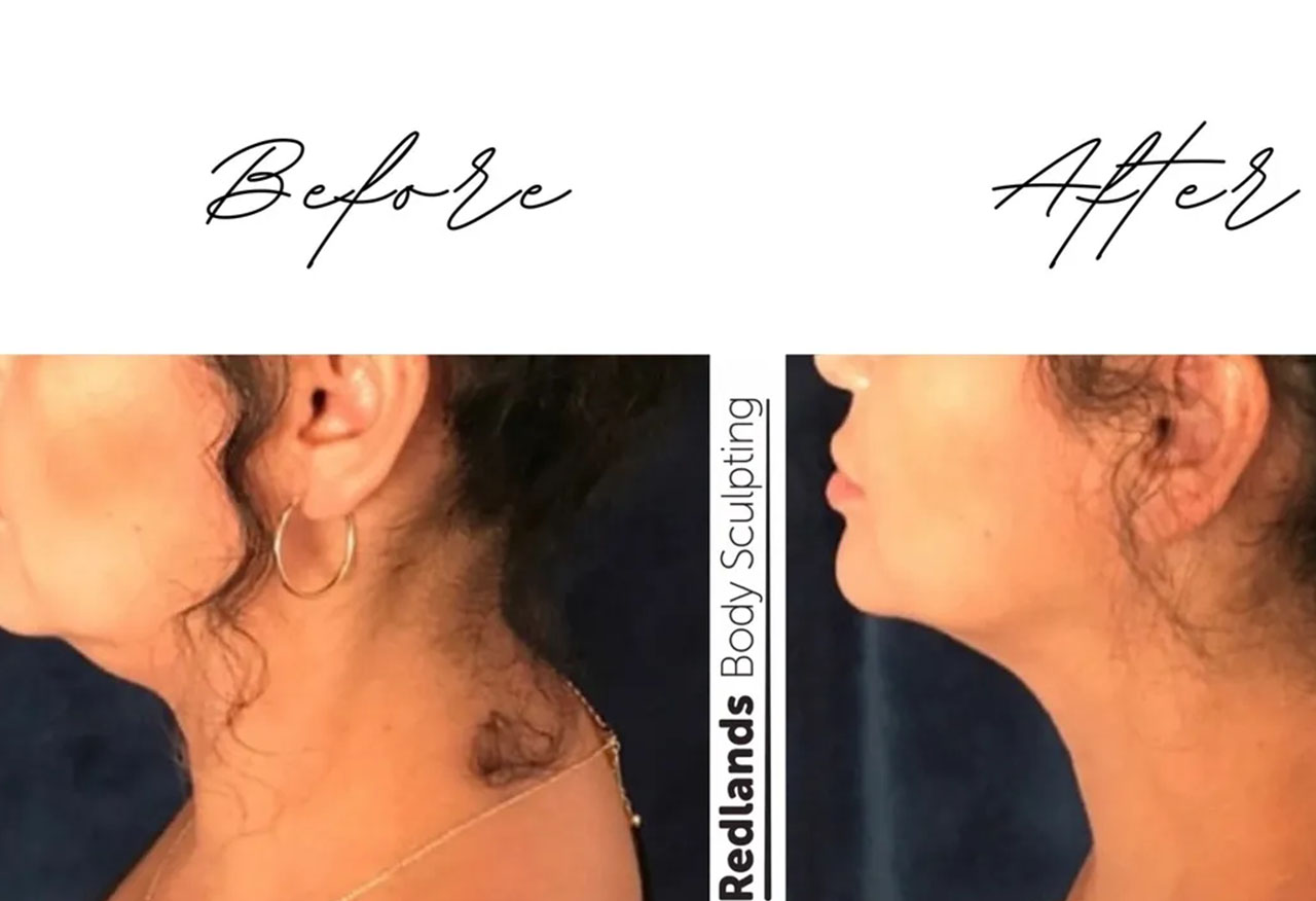 before and after chin coolsculpting treatment at RedLands Body Sculpting with Dr. Aya in California