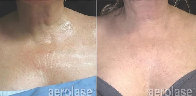 before and after neoskin treatment at RedLands Body Sculpting with Dr. Aya in California