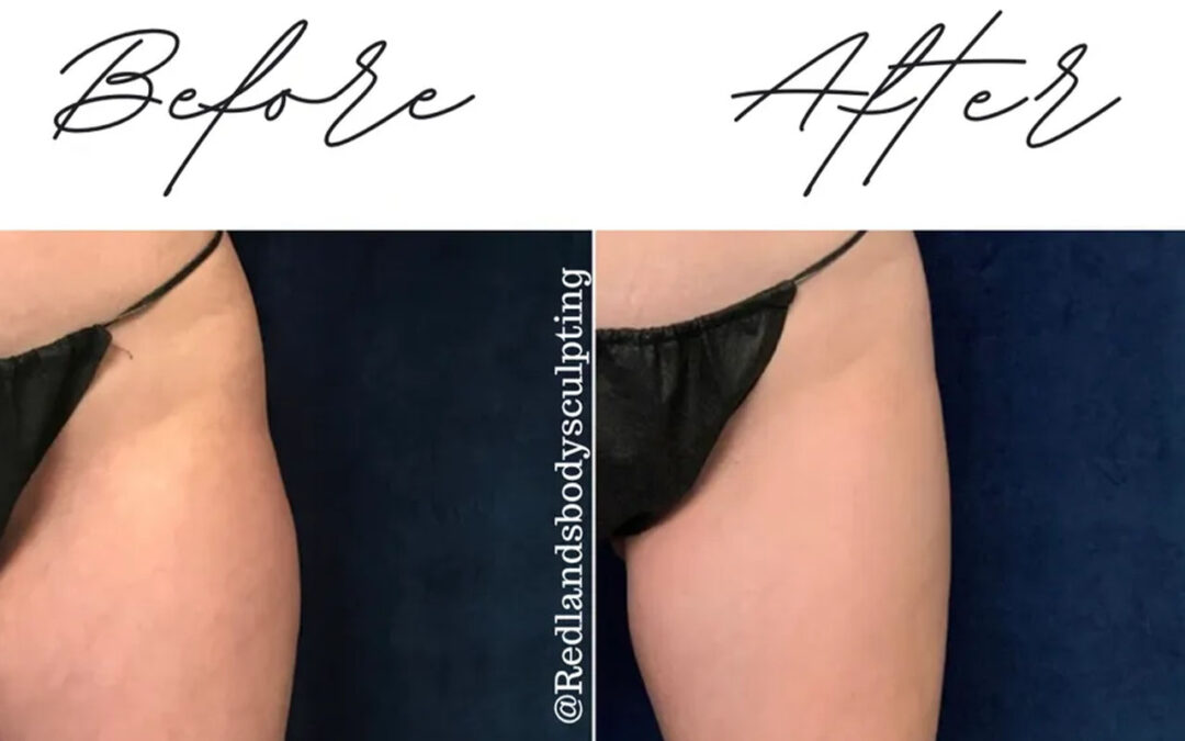 before and after thigh coolsculpting treatment at RedLands Body Sculpting with Dr. Aya in California