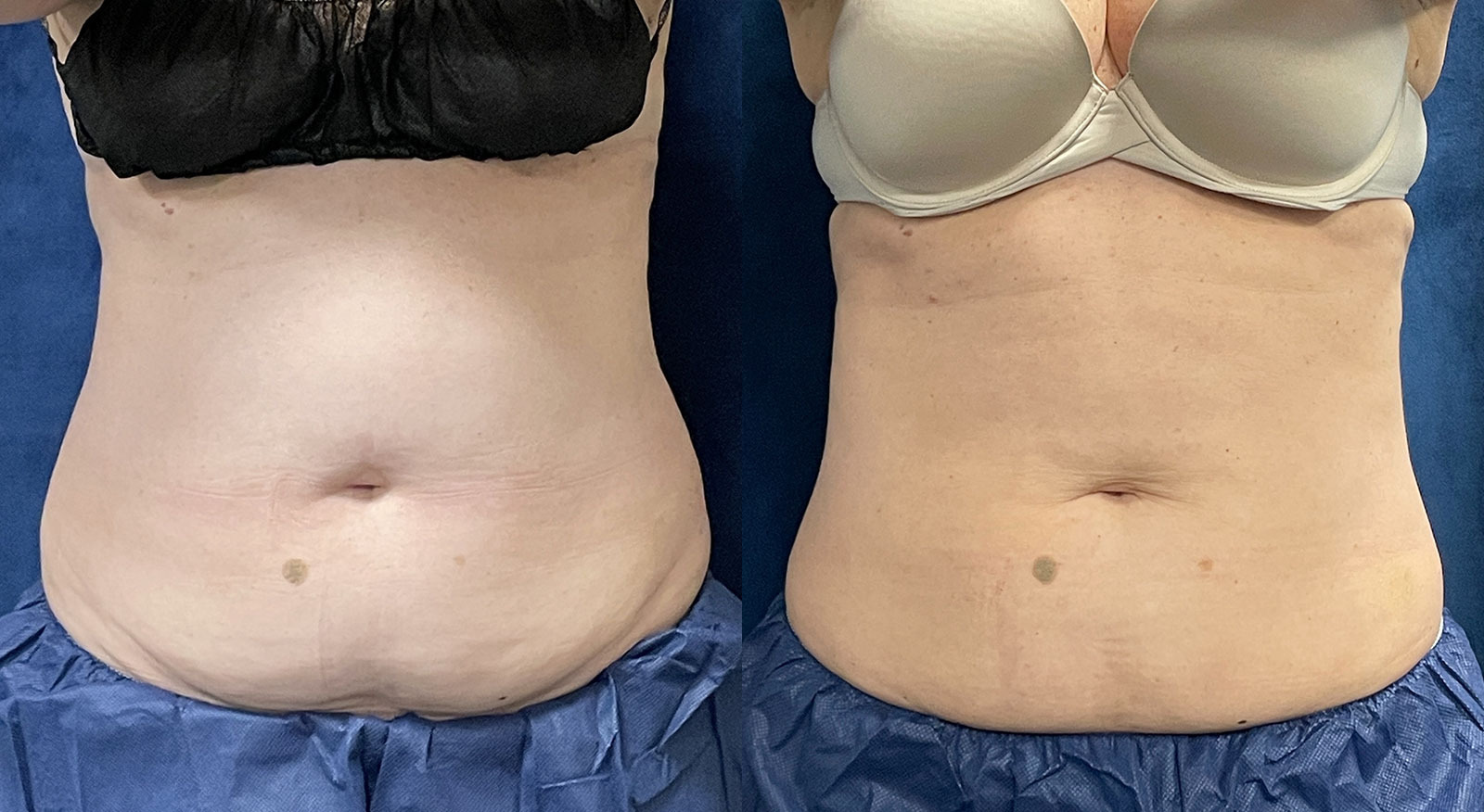 before and after weight loss at RedLands Body Sculpting with Dr. Aya in California